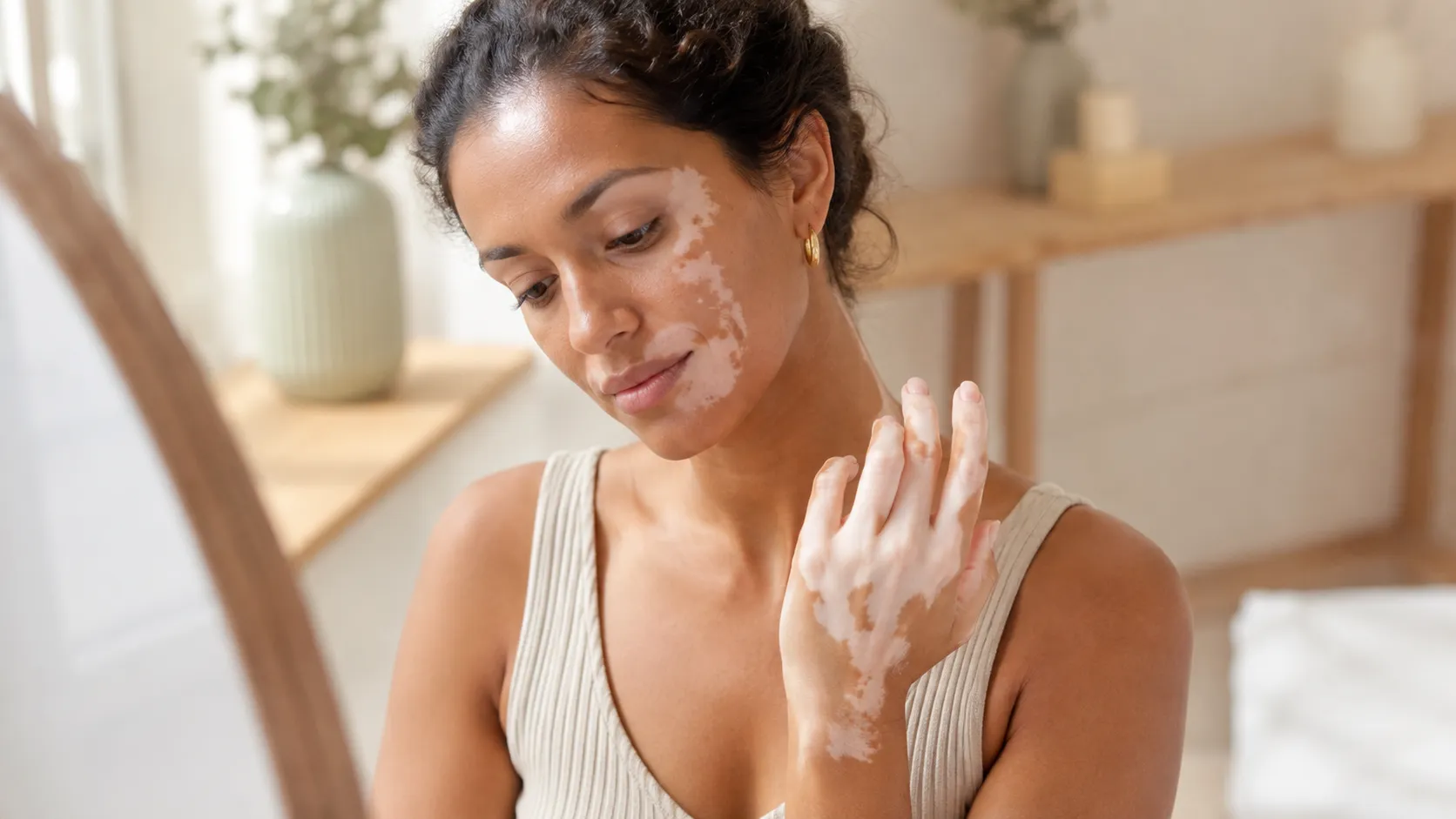 Portrait d’une femme présentant des plaques dépigmentées de vitiligo sur la joue et la main.